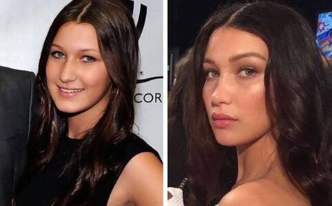 Bella-Hadid-Plastic-Surgery-2.jpg